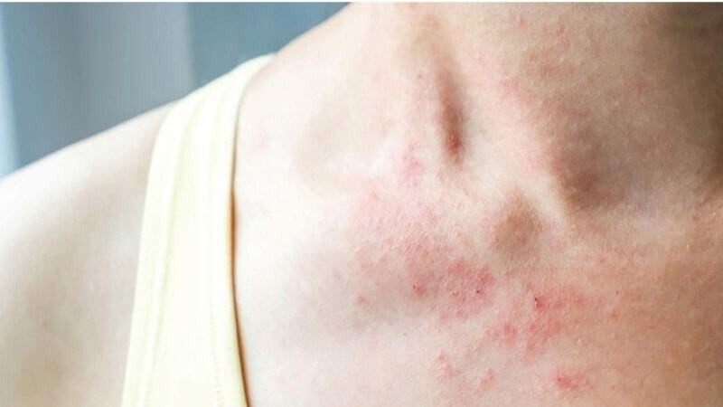 Chiết xuất hạt nho giúp ngăn ngừa tình trạng dị ứng Chiết xuất hạt nho giúp ngăn ngừa tình trạng dị ứng