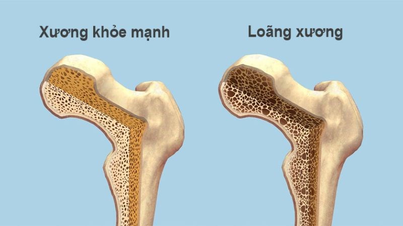 Mùi tây có khả năng hỗ trợ và phòng ngừa loãng xương