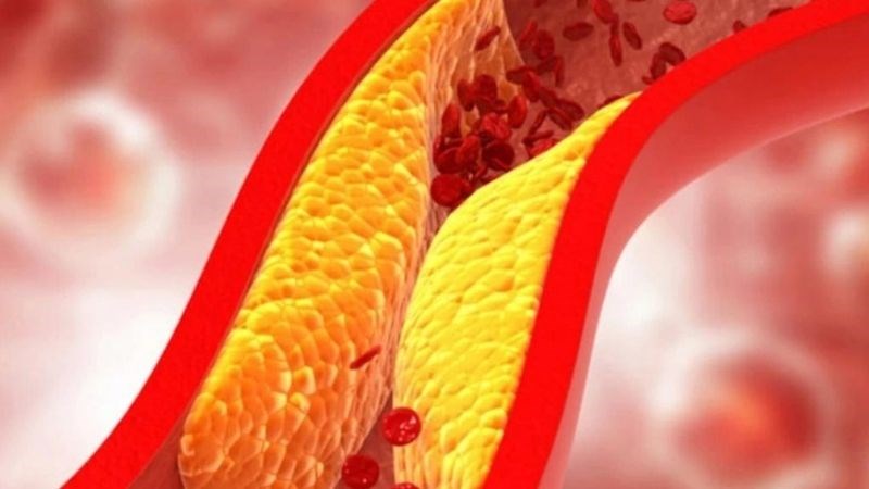 L-Carnitine có thể làm tăng TMAO máu dẫn đến bệnh xơ vữa động mạch