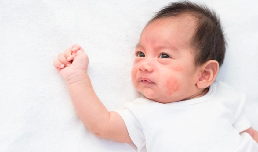 Dị ứng sẽ khiến bé xảy ra tình trạng viêm da, nổi mẩn đỏ ngứa ngáy khắp cơ thể