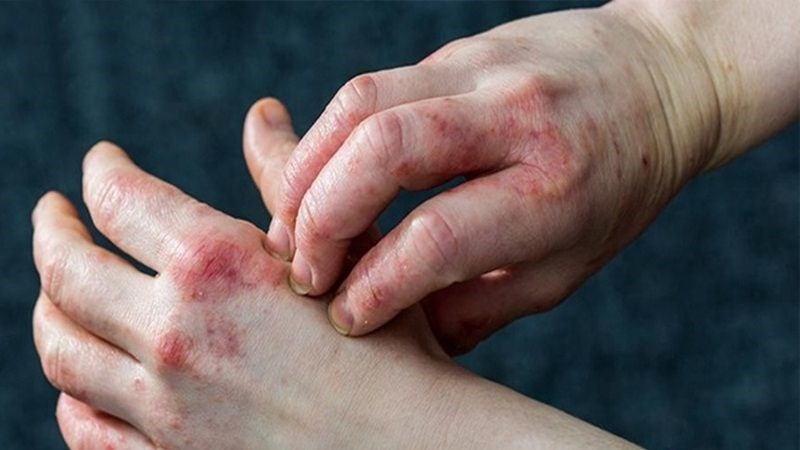 Vi khuẩn L. acidophilus có thể làm giảm và ngăn ngừa bệnh chàm hiệu quả