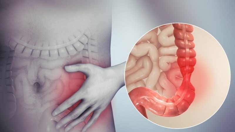 Uống L. acidophilus có thể làm giảm triệu chứng viêm ruột