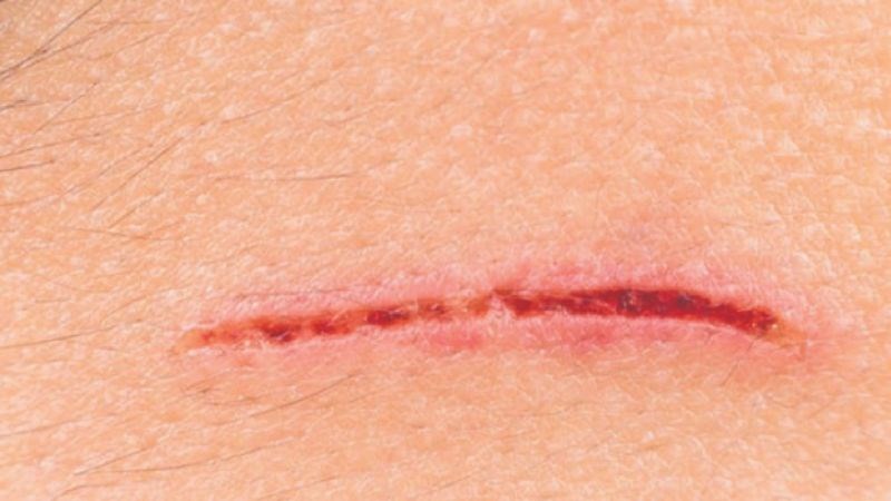 Quế có khả năng thúc đẩy quá trình chữa lành vết thương