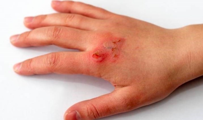 Dùng mù u để trị bỏng, trị sẹo Dùng mù u để trị bỏng, trị sẹo