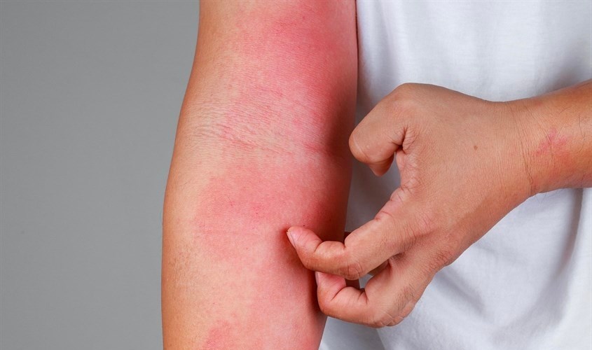 Công dụng và cách sử dụng dầu mù u cho vết thương hở bạn cần biết