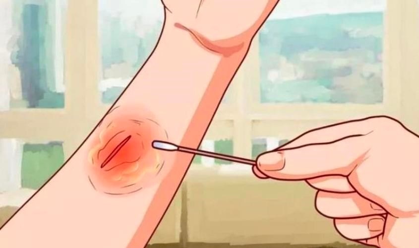 Pha loãng và bôi lên vết thương Pha loãng và bôi lên vết thương