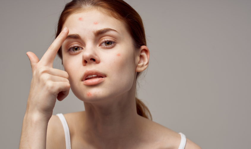 Kích ứng với thành phần sữa rửa mặt