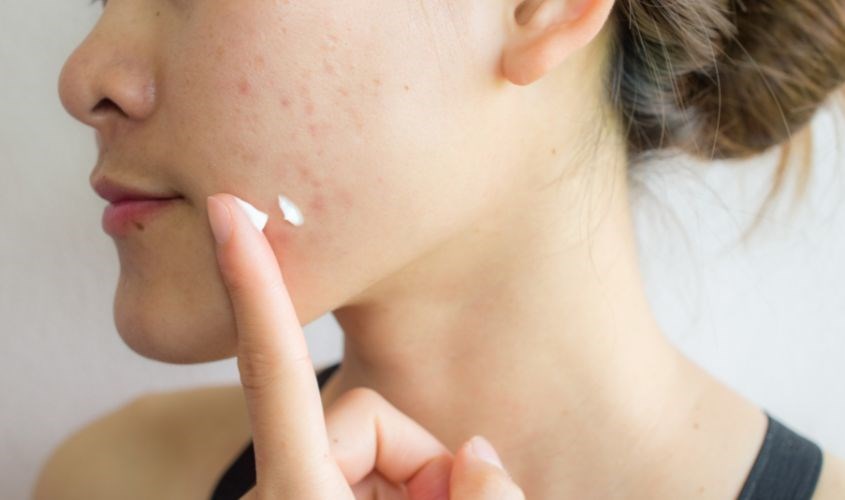 Các bước sử dụng kem trị mụn đúng quy trình