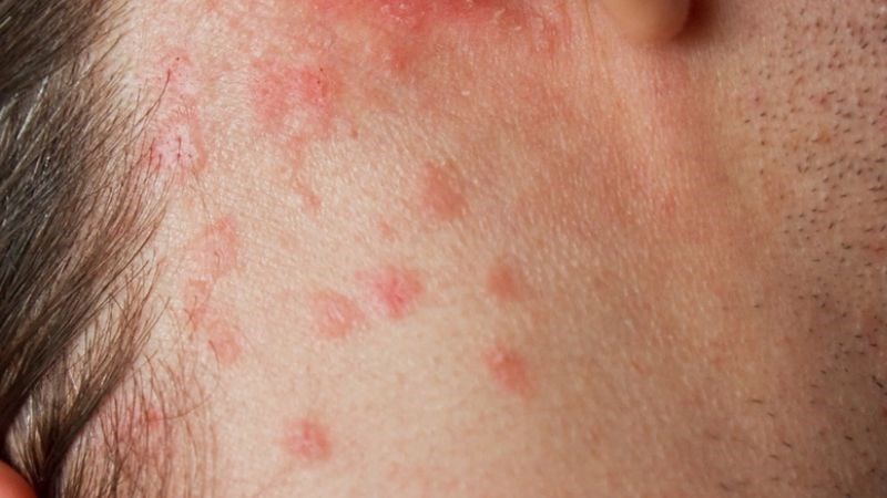 Viêm nang lông là tình trạng bị nhiễm trùng, tắc nghẽn hay kích ứng nang lông trên da 