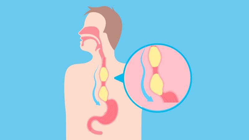 Co thắt thực quản xảy ra khi cơ trơn thực quản co giãn kém