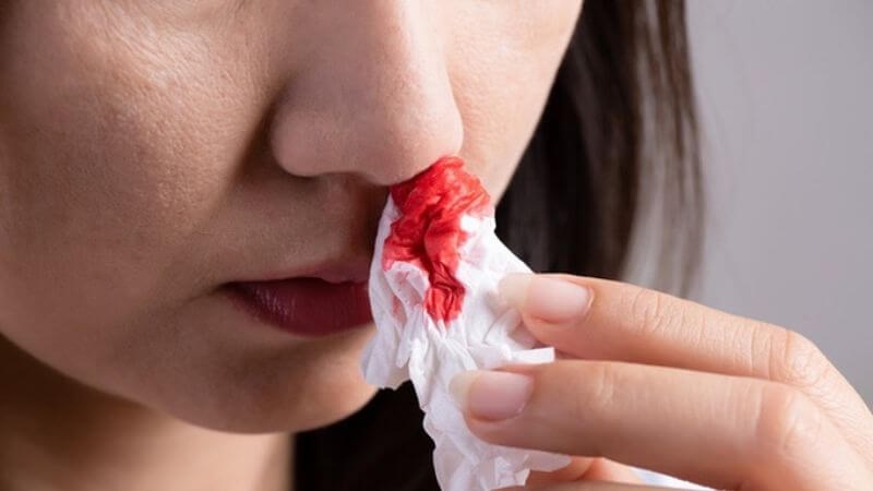 Chảy máu cam là tình trạng máu chảy ra từ mũi
