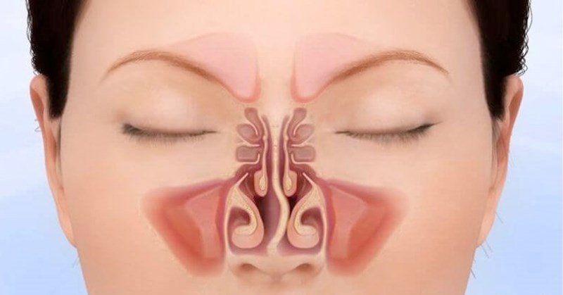 Bất thường cấu trúc mũi có thể gây nên tình trạng niêm mạc mũi bị khô