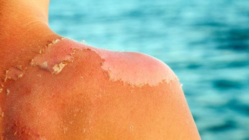 Cháy nắng là tình trạng da ửng đỏ, bỏng rát khi đi ngoài nắng