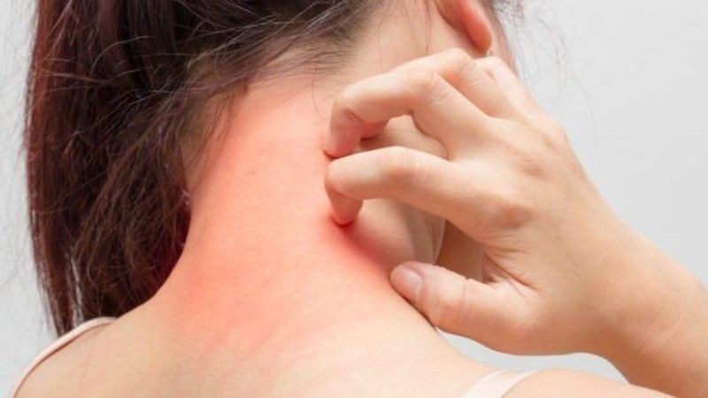Bạn không nên gãi vùng da bị cháy nắng để tránh tổn thương nặng thêm