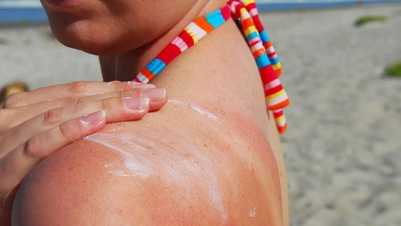 Vùng da tiếp xúc với ánh nắng chuyển sang màu đỏ hoặc hồng là dấu hiệu cháy nắng
