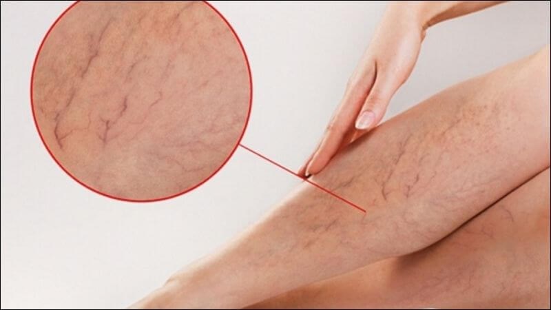 Saponin trong rau má giúp hỗ trợ điều trị suy giãn tĩnh mạch Saponin trong rau má giúp hỗ trợ điều trị suy giãn tĩnh mạch