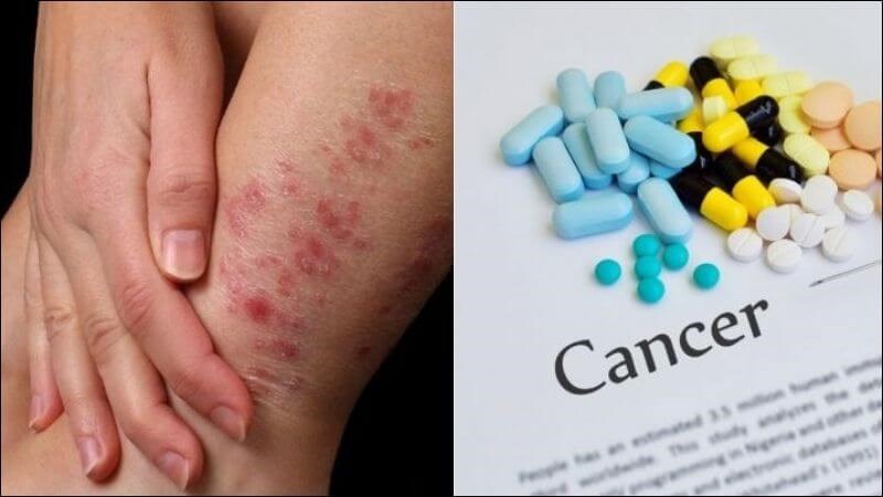 Thành phần hóa học trong rau má giúp hỗ trợ điều trị bệnh phong và ung thư Thành phần hóa học trong rau má giúp hỗ trợ điều trị bệnh phong và ung thư