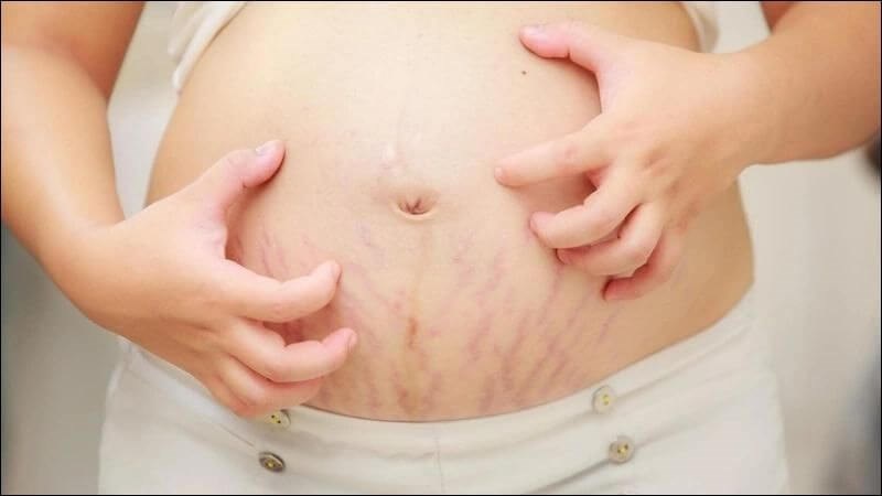 Hoạt chất terpenoid trong rau má có tác dụng ngăn ngừa các vết rạn da Hoạt chất terpenoid trong rau má có tác dụng ngăn ngừa các vết rạn da