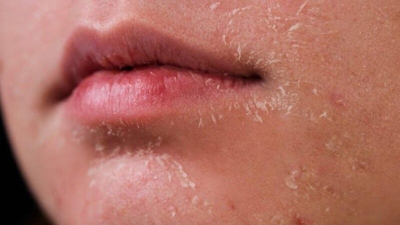 Tình trạng da khô sẽ góp phần hình thành những vết nứt đỏ trên da