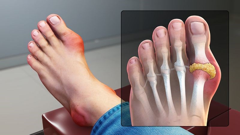 Gout là một tình trạng bệnh lý viêm khớp gây viêm, sưng và đau các khớp