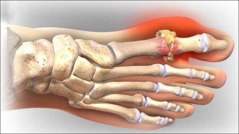 Tỷ lệ mắc bệnh gout cao hơn ở những nước ăn nhiều thịt đỏ và thực phẩm chế biến sẵn