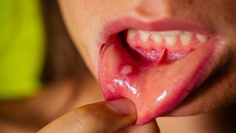 Vết lở loét niêm mạc miệng