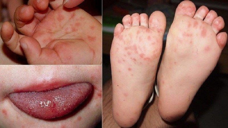 Phát ban ở tay, chân và trên mặt