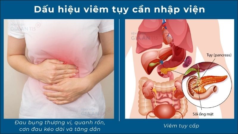 Viêm tụy cấp