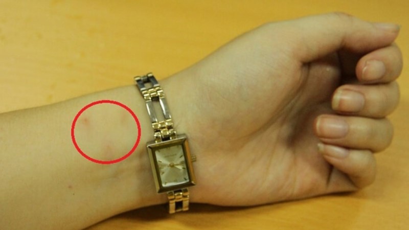 Mồ h&ocirc;i chứa nhiều muối v&agrave; dầu t&aacute;c dụng với kim loại khiến cổ tay bị ngứa ng&aacute;y 