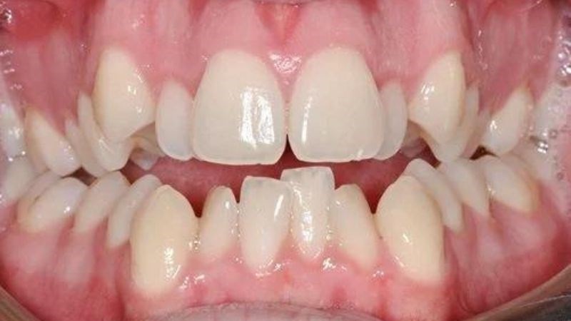 Răng nên được nhổ bỏ khi mọc chen chúc và cần chỉnh nha