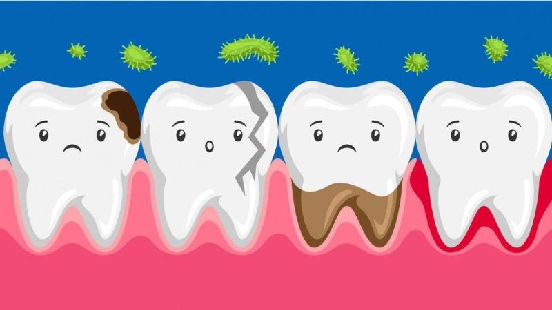 Nhổ răng giúp ngăn ngừa hư hỏng các răng lân cận