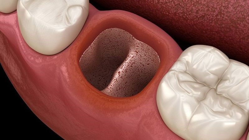 Mất đến 2 tuần để hồi phục hoàn toàn sau khi nhổ râng