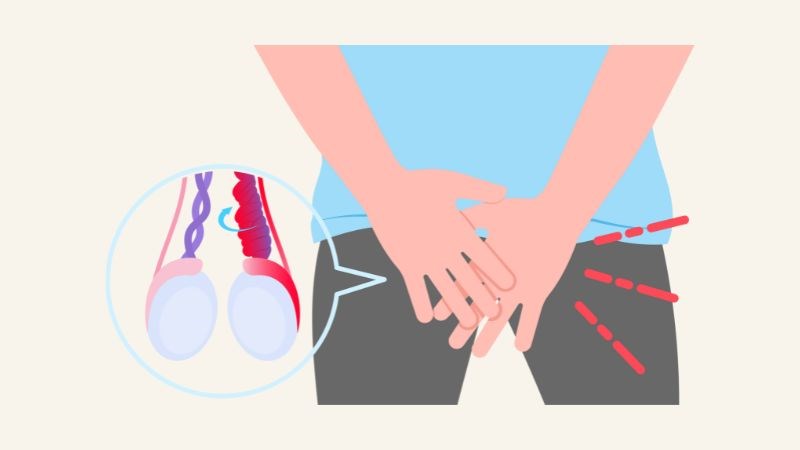 Giãn mạch thừng tinh là tình trạng các tĩnh mạch trong thừng tinh bị giãn nở và xoắn bất thường