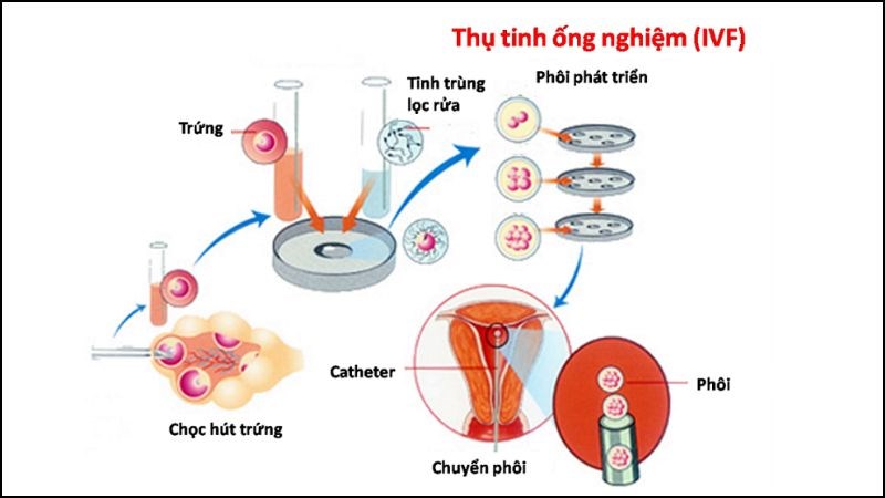 Cách chữa bệnh vô sinh nam giới thông qua IVF