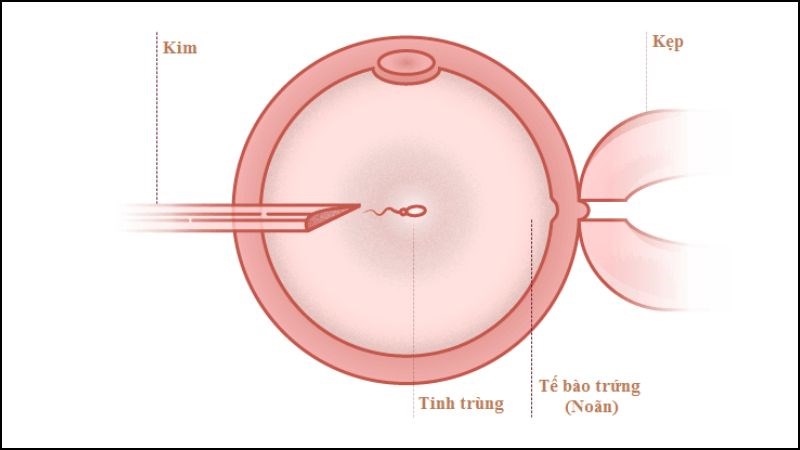 Tiêm tinh trùng vào bào tương là một trong những cách trị vô sinh nam giới