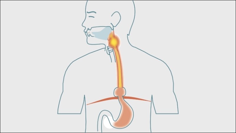 Trào ngược dạ dày thực quản gây ra cảm giác khó chịu như ợ hơi, nóng rát