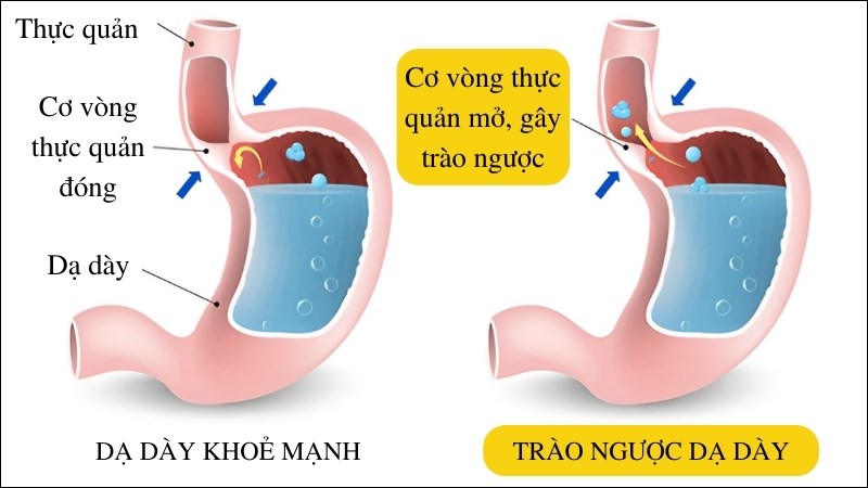 Trào ngược dạ dày do acid trong dịch vị đẩy ngược lên thực quản