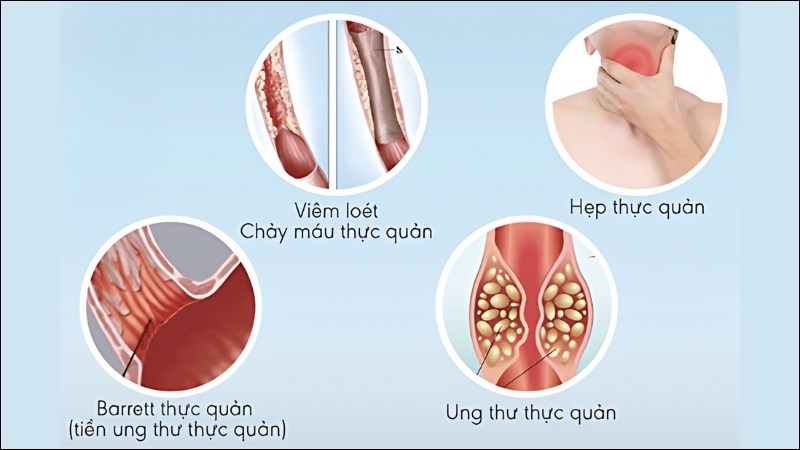 Acid dạ dày trào lên thực quản gây ra nhiều biến chứng nguy hiểm cho người bệnh