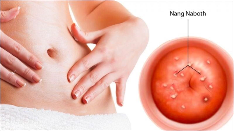 Nang Naboth hình thành ở vị trí cổ tử cung Nang Naboth hình thành ở vị trí cổ tử cung