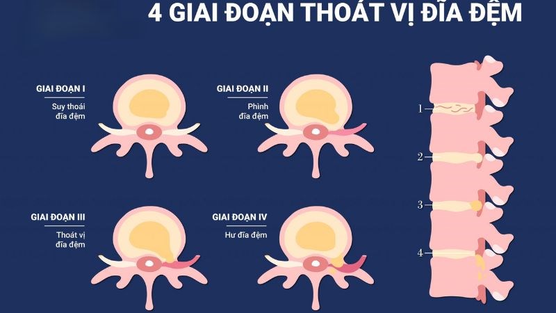 Thoát vị đĩa đệm có thể gây ra đau lưng