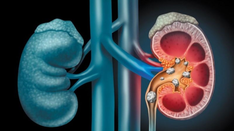 Sỏi thận có thể gây đau lưng