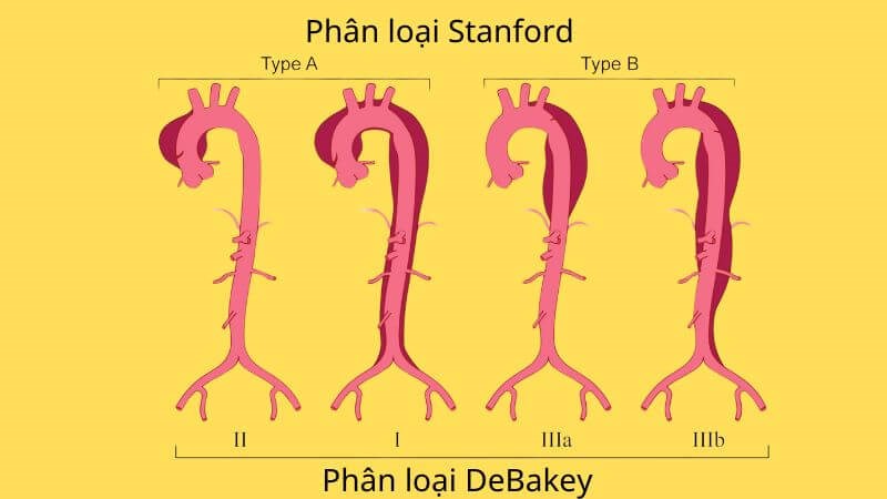 Phân loại bóc tách động mạch chủ dựa vào vị trí bóc tách