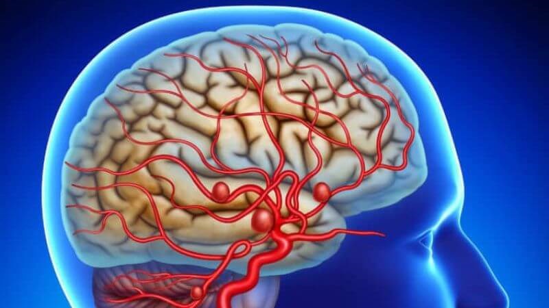 Phình mạch máu não là bệnh xảy ra trong âm thầm