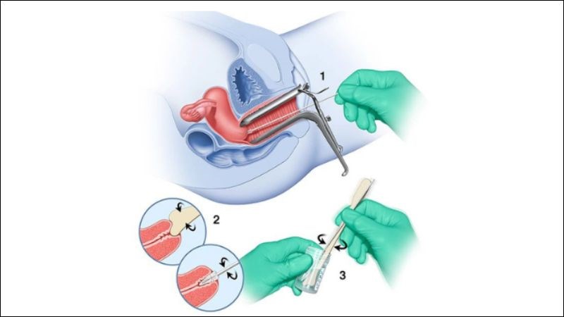 Xét nghiệm Pap smear giúp phát hiện tế bào bất thường