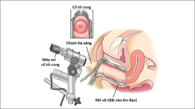 Soi cổ tử cung giúp phát hiện tổn thương chưa có triệu chứng lâm sàng