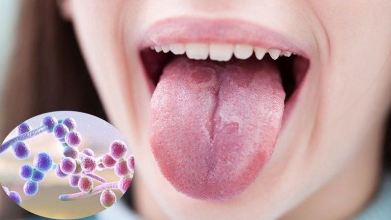 Nấm sinh sôi và phát triển trong miệng gây cảm giác đắng miệng