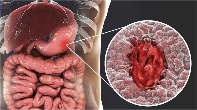 Ung thư dạ dày là một căn bệnh phổ biến hiện nay