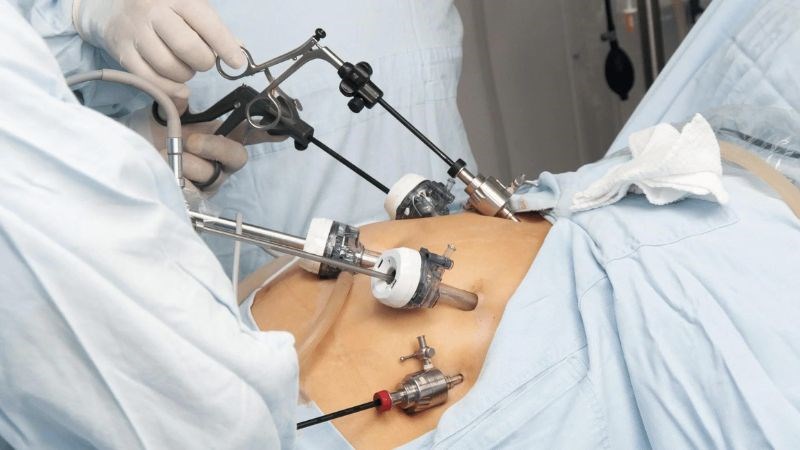 Ung thư dạ dày có thể được chữa khỏi thông qua phẫu thuật nội soi