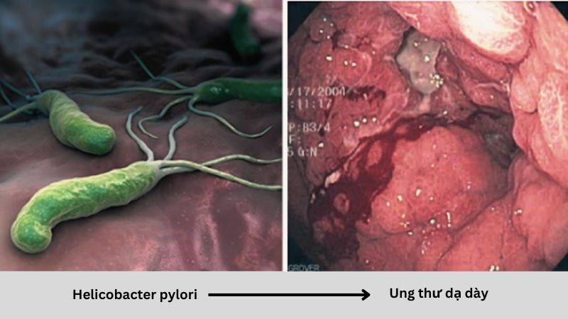 Helicobacter pylori, một loại vi khuẩn có thể gây ung thư dạ dày