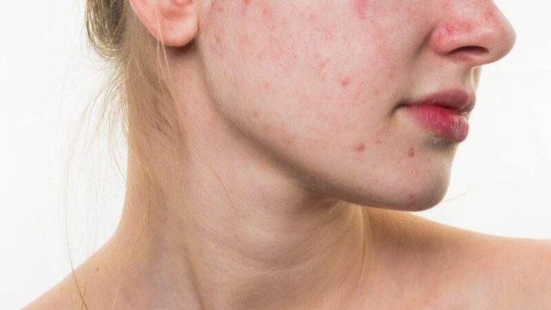 Nếu tẩy tế bào chết không đúng cách sẽ làm da bị kích ứng, khô da, gây ra tình trạng mụn
